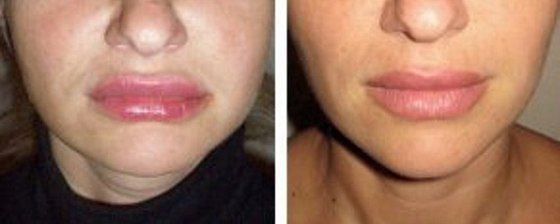 Пластика губ. Короткий И.В.: до и после – фото 12