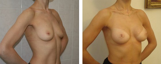 Маммопластика. Еременко В.С._12: до и после – фото 9