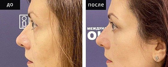 Блефаропластика нижняя. Зварич 05: до и после – фото 51
