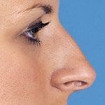 Горбинка или удлиненный кончик носа